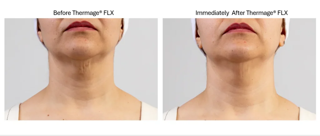 Thermage antes y después cuello