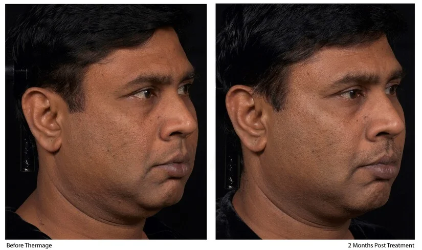 Thermage facial en hombres