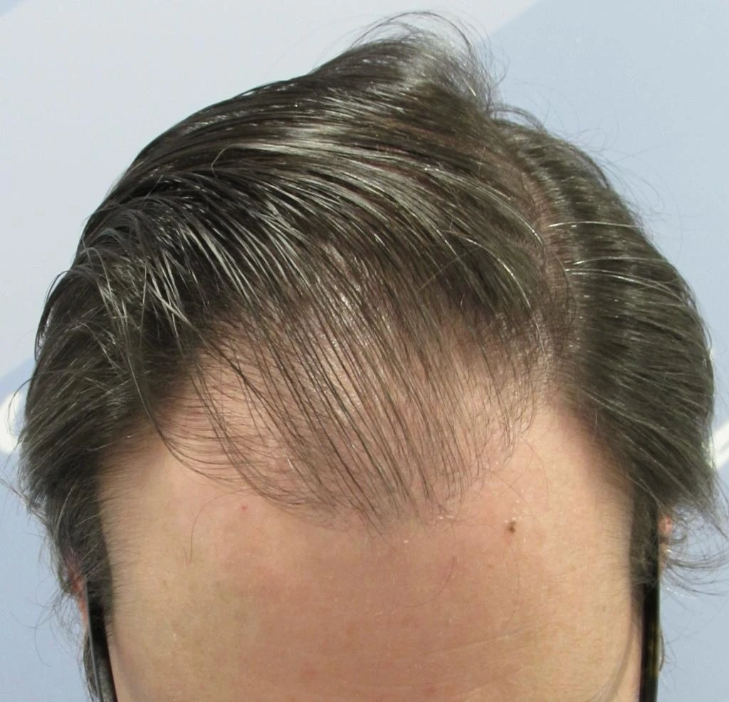 Antes de trasplante capilar de pelo largo sin rasurar