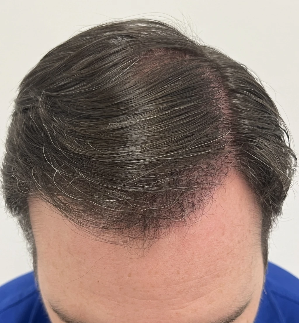 Resultado al año de trasplante capilar de pelo largo