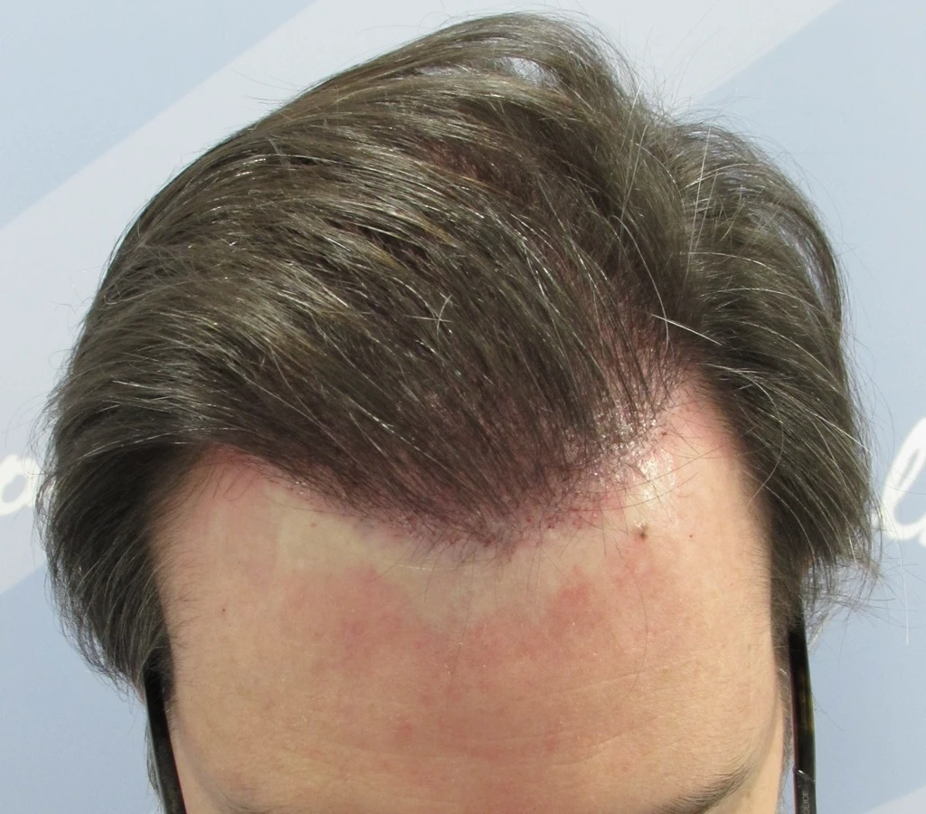 Resultado inmediato tras trasplante capilar de pelo largo