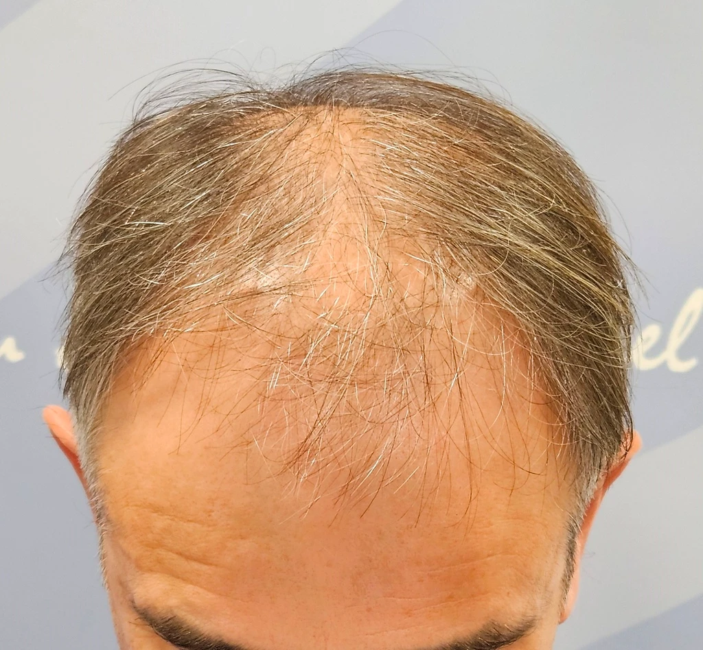 Antes de trasplante capilar FUE de pelo largo sin rasurar