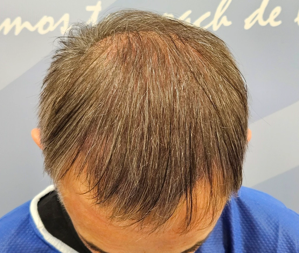 Resultado inmediato tras trasplante capilar FUE de pelo largo sin rasurar
