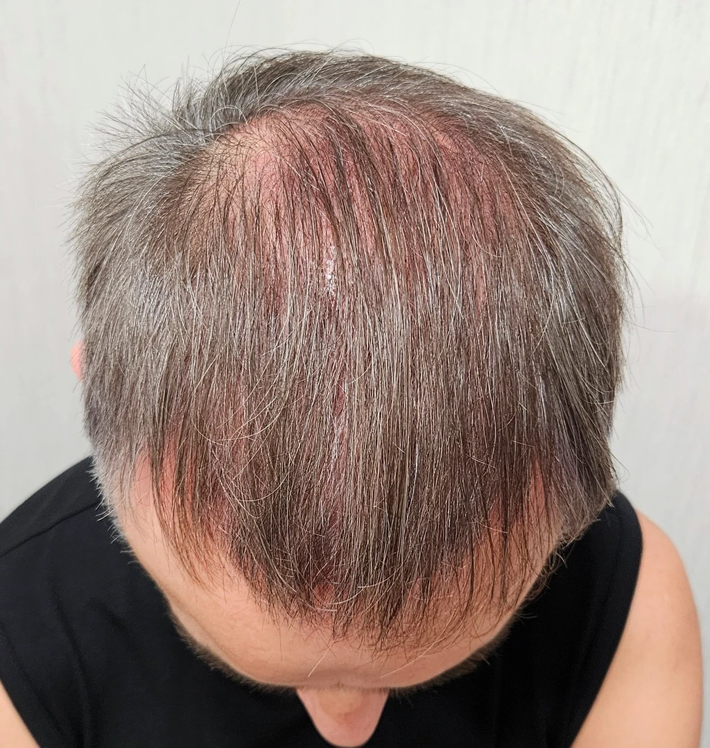 Resultado al año de trasplante capilar FUE de pelo largo